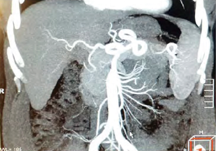 CT打顯影劑掃描腹部的動脈影像